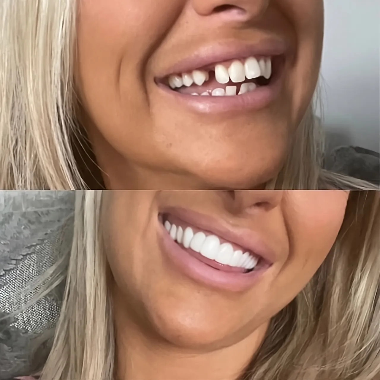 SnapBright™ Veneers